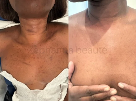 Peeling Eclair Zepharma - Retrouvez l’éclat naturel de votre peau grâce au Peeling Éclair Zepharma.