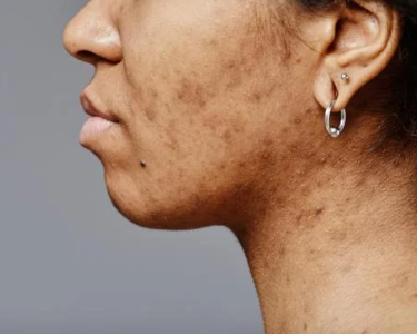 Microneedling Tâches Zepharma ⚜ – Éclat et uniformité du teint