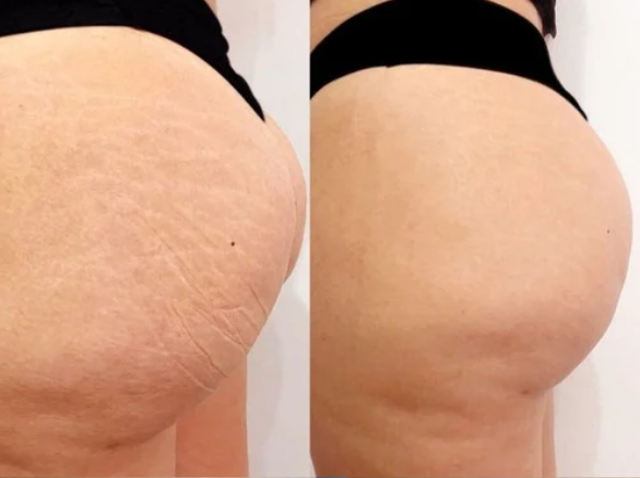 Peeling Vergetures Zepharma ⚜ – Soin rénovateur pour une peau lissée et uniforme