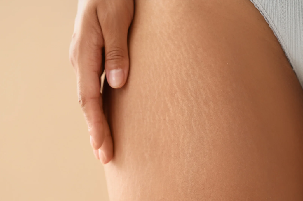 Peeling Vergetures Zepharma ⚜ – Soin rénovateur pour une peau lissée et uniforme