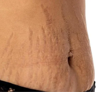 Microneedling Vergetures Zepharma ⚜ – Rénovation et fermeté de la peau